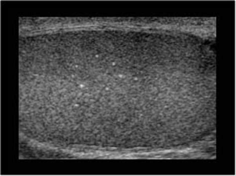 Urinary Tract and male reproductive system | 2.3 Scrotum : Case 2.3.13 Microlithiasis and ...