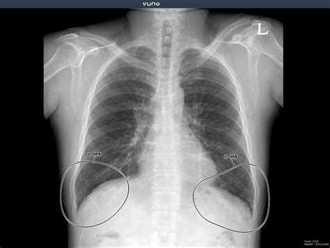 Anatomy Of Chest X Ray / Cureus Predicting Covid 19 Pneumonia Severity ...