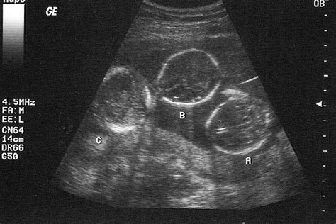 Triplet babies, Triplets pregnancy, Triplets