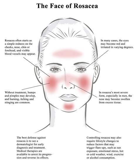 It’s Becoming Clear: Rosacea Awareness Month Highlights Potential Causes of Rosacea