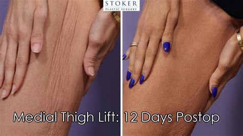 Medial Thigh Lift Los Angeles: Plastic Surgeon Dr. Stoker Transforms Body After Weight Loss ...