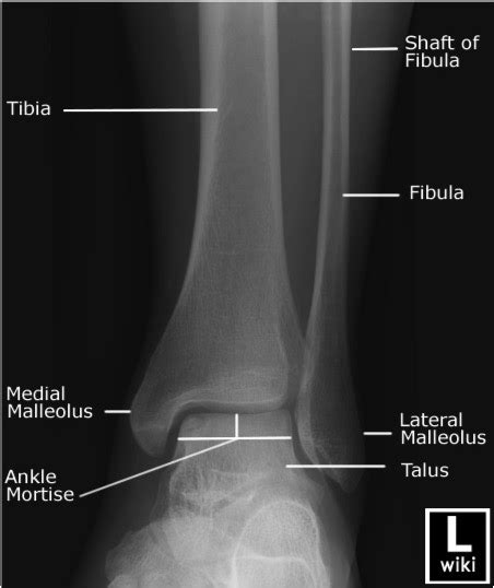 Adult Ankle Radiographs - Trauma - Orthobullets