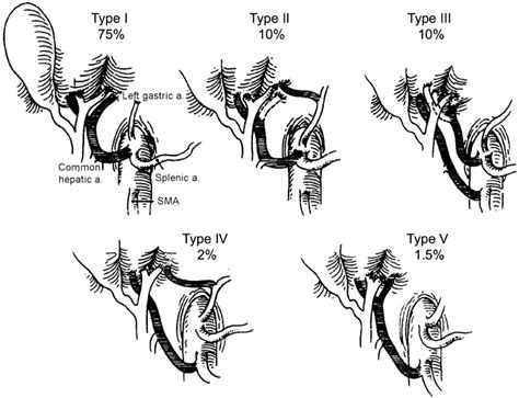 Intraoperative Injury to Hepatic Arterial Structures | Abdominal Key