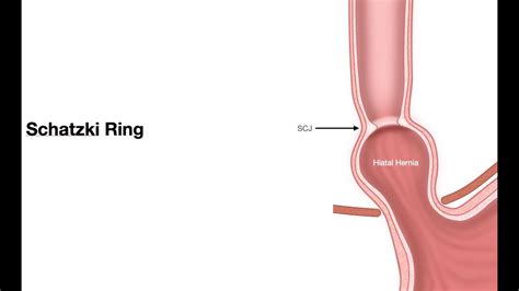 ECE-Lesson 2f5-Pathology of Esophagus-Schatzki ring - YouTube