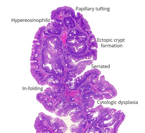 Traditional serrated adenoma : r/pathology