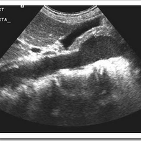 Ultrasound images of Aortic aneurysm - Radiology Imaging