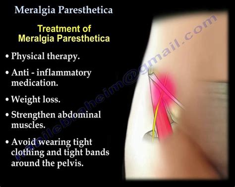 26 best Meralgia Parasthetica images on Pinterest