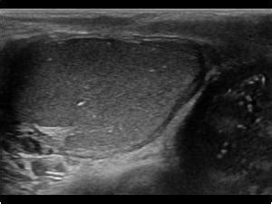 Urinary Tract and male reproductive system | 2.3 Scrotum : Case 2.3.13 Microlithiasis and ...