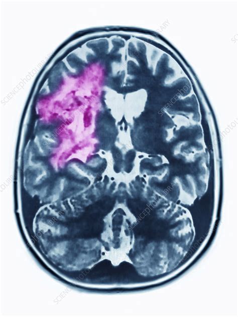 Astrocytoma Mri - Stock Image - C021/3874 - Science Photo Library