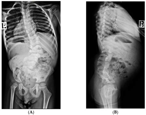 Sacral Agenesis X Ray