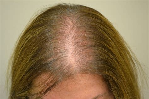 Alopecia androgenetica maschile: Cause, Cure, Sintomi e Rimedi - Ricrescitacapelli24.com