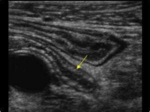 Abdomen and retroperitoneum | 1.5 Appendix : Case 1.5.1 Normal appendix | Ultrasound Cases