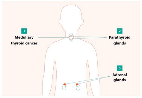 Multiple Endocrine Neoplasia Type 2 (MEN2)