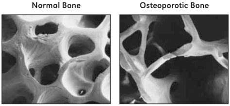 Figure 2-5, Normal vs. Osteoporotic Bone - Bone Health and Osteoporosis ...