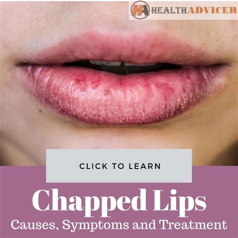 Chapped Lips: Causes, Picture, Symptoms And Treatment