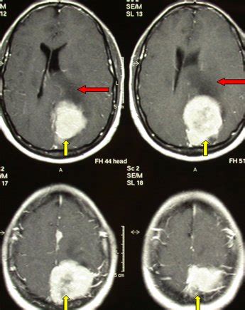 Benign Brain Tumors