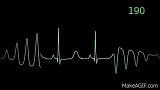 Heart Monitor Flatline Gif