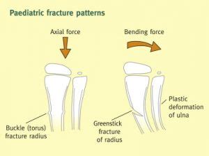 Greenstick & Buckle Fracture - Activate Physiotherapy