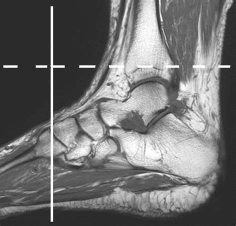 Foot Muscles Mri Anatomy - - Tendinous, ligamentous, and muscle ...