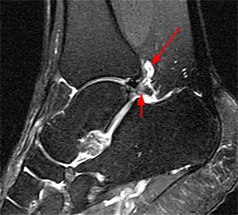 Posterior Ankle Impingement | Radsource