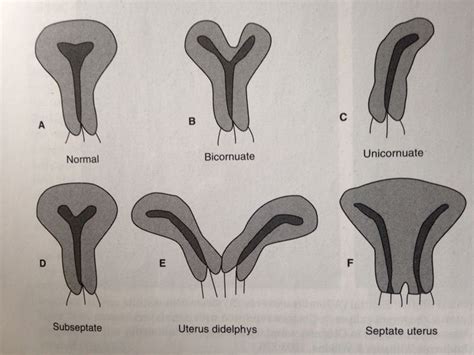 ¿Qué es una anomalía uterina y cómo afecta el embarazo?