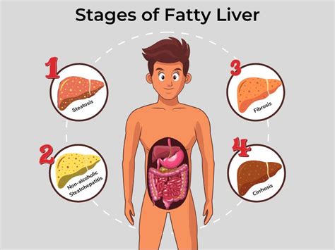 Fatty Liver - Types, Symptoms, Stages, and Treatment