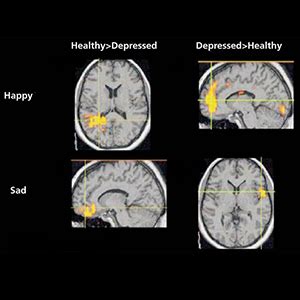 Brain scans could predict major depression risk - MassDevice