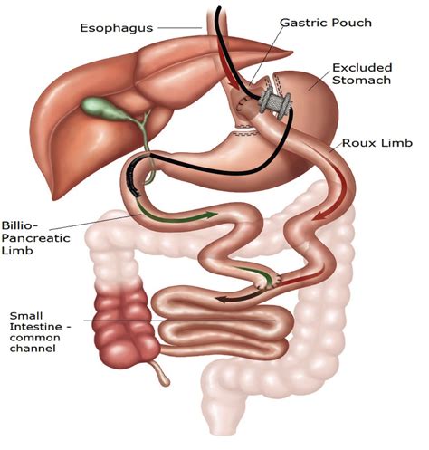 Internal EDGE (EUS-Directed Transgastric ERCP) Procedure Dallas & Plano ...