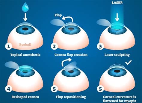 LASIK Surgery Cost St. Petersburg, FL - St. Michael's Eye