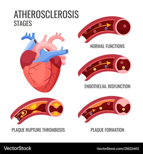 Stages Of Atherosclerosis Development