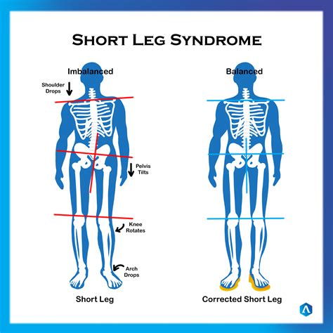 Short Leg | Dr. Abbie Clinics