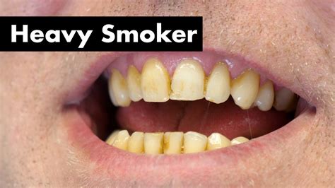 Cleaning Smoker's Teeth with Heavy Stain | Teeth Cleaning - Dental Clinic