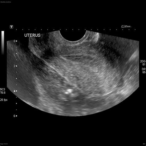 Ruptured Ectopic Pregnancy Ultrasound