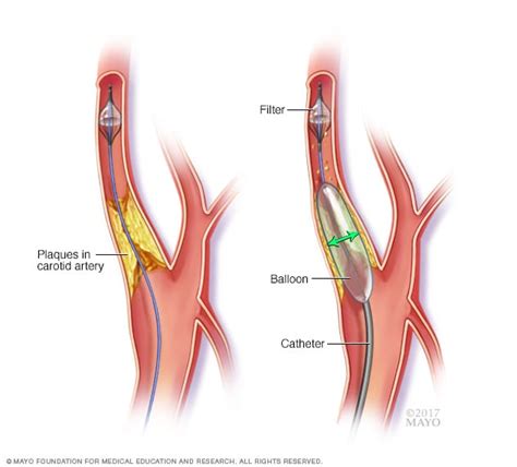 Carotid angioplasty - Mayo Clinic