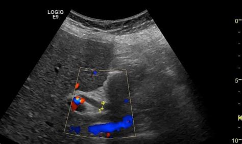 Ultrasound Case 049 • LITFL • POCUS Self-Assessment Quiz