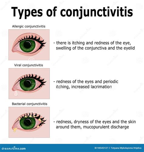 Tipos de conjuntivitis ilustración del vector. Ilustración de ...