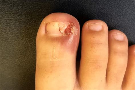 Prevention and Treatment for Recurring Ingrown Toenails - An Tâm