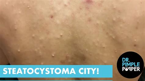 Steatocystoma City! - Dr. Pimple Popper