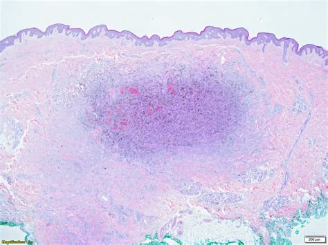 Pathology Outlines - Dermatofibroma (cutaneous fibrous histiocytoma)