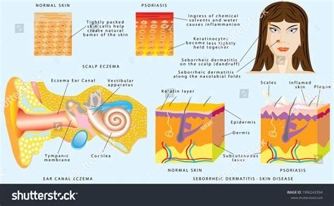 7 Psoriasis Ear Canal Images, Stock Photos, 3D objects, & Vectors | Shutterstock