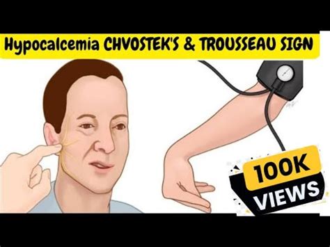 Hypocalcemia (Signs and Symptoms) - CHVOSTEK'S & TROUSSEAU SIGN. - YouTube