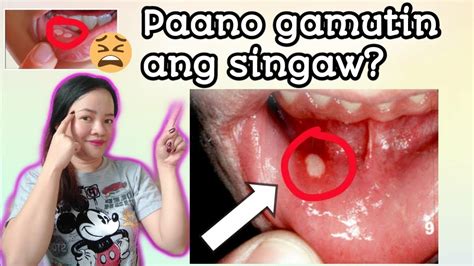 Gamot sa Singaw | Paano gamutin ang singaw or canker sores | home ...