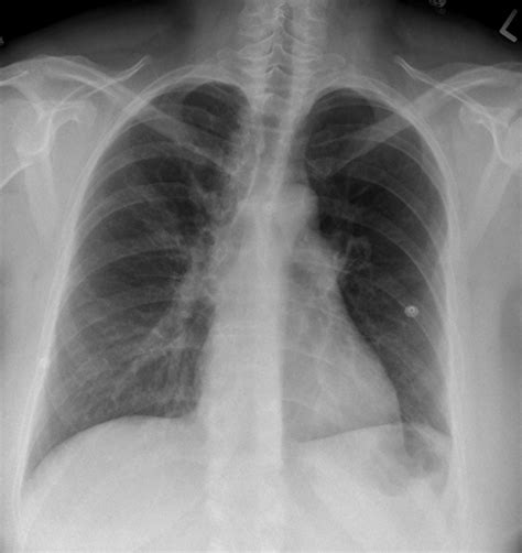 Pulmonary Thromboembolism – Undergraduate Diagnostic Imaging Fundamentals