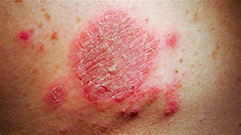 Eczema: Symptoms, Treatment, Causes, More