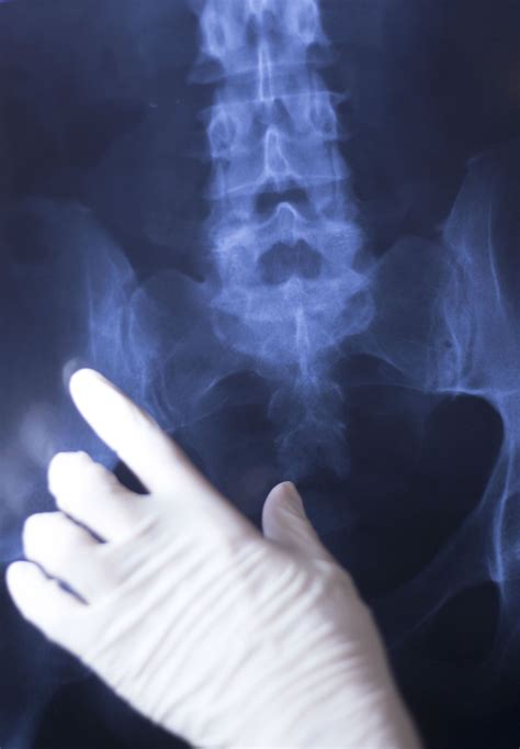 Man Alleges Severe Stryker LFIT Hip Replacement Complications