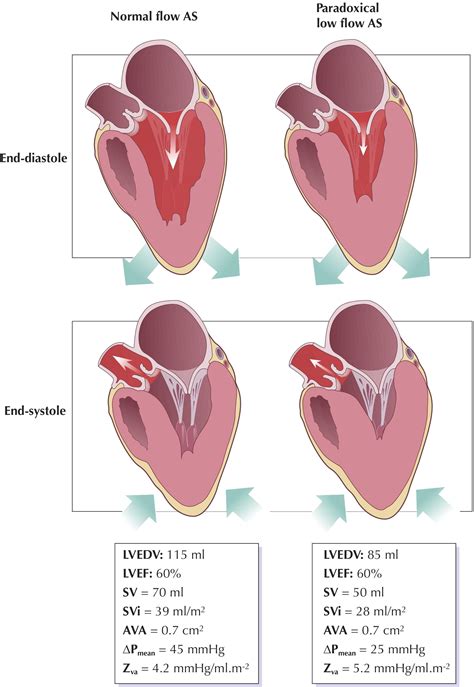 Aortic Stenosis: Look Globally, Think Globally⁎ | JACC: Cardiovascular ...