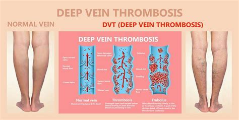 Knowing Your Risk for DVT