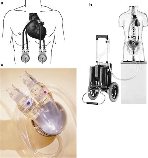 Right Ventricular Assist Devices | Thoracic Key