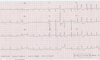 Ashman Phenomenon Workup: Other Tests