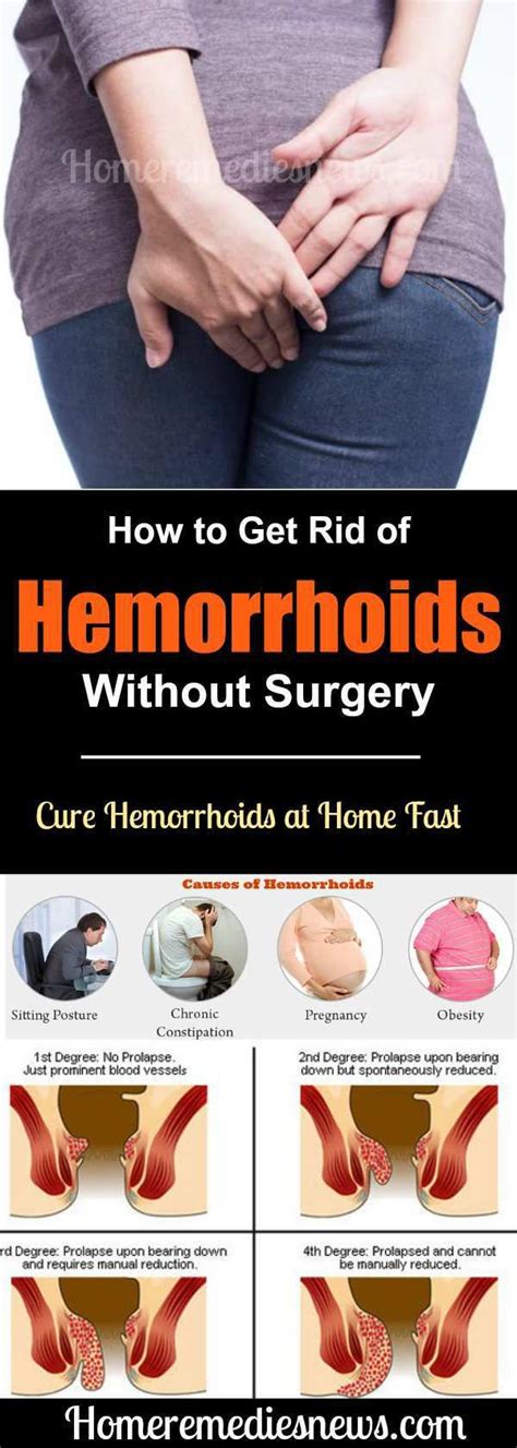 How to Get Rid of Hemorrhoids Without Surgery | Home remedies for ...